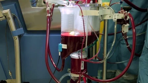 Close-up of a functioning heart-lung machine with a large reservoir of blood Stock Footage 74214659