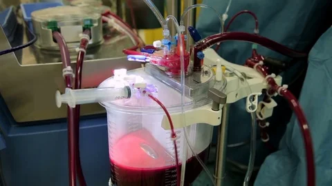 Close-up of a functioning heart-lung machine with a large reservoir of blood Stock Footage 74214739