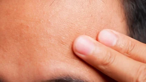 A close-up of gentle circular temple massage. Stock Footage 321667556