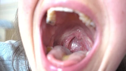 Close up glance in to sore throat of an Stock Video Pond5