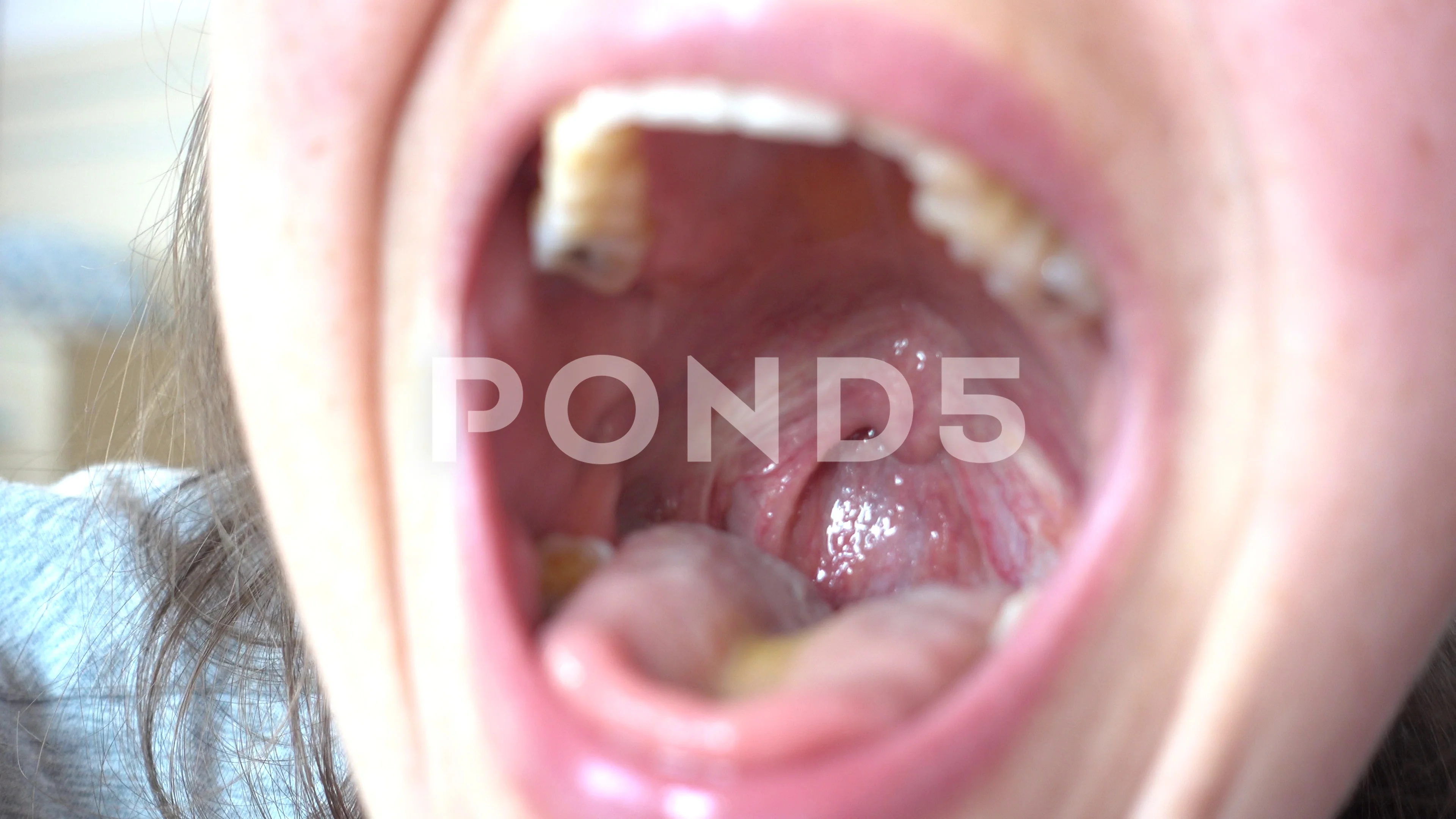 Close up glance in to sore throat of an adult woman