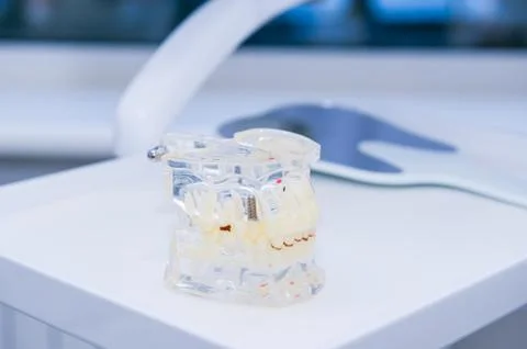 Close up glass jaw model with implanted dentures on the working dental table Foto stock