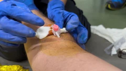 Close Up Of Gloved Hands Securing An Intravenous Catheter In Forearm Video stock 341732421