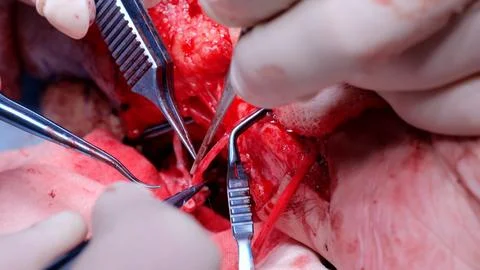 Close up of gloved hands using specialized tools during a complex surgical Stock Photos