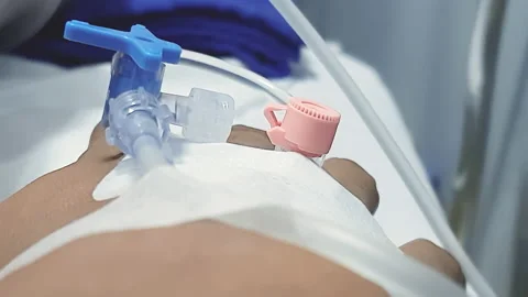 Close Up Guy's Right Hand With IV Trying To Move His Fingers Stock Footage 140427947