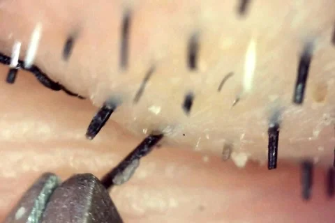 Close-up of hair being pulled out from follicle with tweezers Stock Footage 333611879