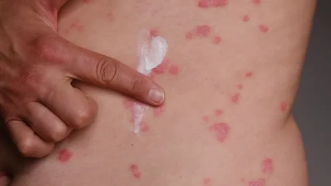 Close-up of hand applying cream on psoriasis patches on skin, showing Stock Footage 337462776