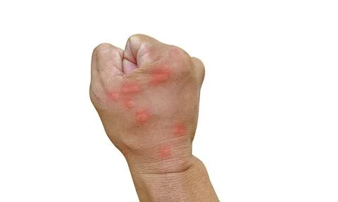 Close-up Hand bee stinging hand insects worker skin allergy, allergic treat.. Stock Photos