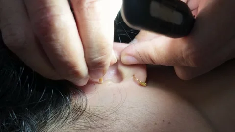 Close Up of Hand Cleaning Ear with Cotton Swab Stock Footage 344087455