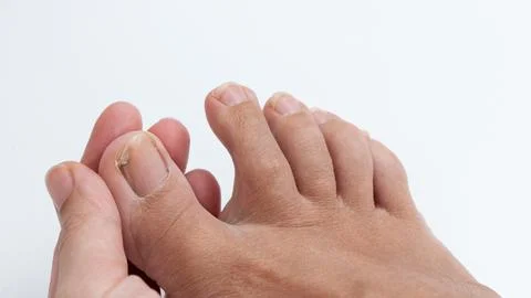 Close-up of a hand examining a foot with a damaged toenail, highlighting the Stock Photos