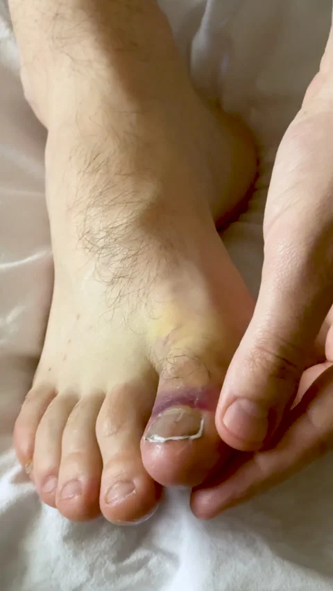 Close-up of a hand examining a swollen toe with visible hematoma on a foot Video stock 335524280