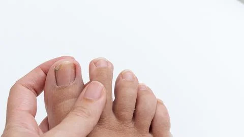 Close-up of a hand examining toes, showcasing foot health and hygiene, with a Stock Photos