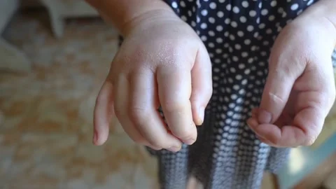 Close-up hand inflammation. Left hand was very swollen in region of the cartilag Stock Footage 201469246