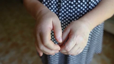 Close-up hand inflammation. Left hand was very swollen in region of the cartilag Stock Footage 201469251