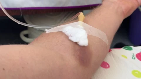 Close-up of a hand with an intravenous catheter inserted. Intravenous therapy Stock Footage 307177987