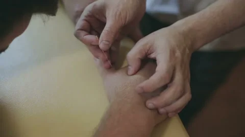 Close-up of hands and needles. Alternative Chinese medicine. Stock Footage 68964496