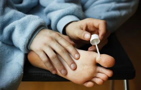 Close-up of hands of a boy applying warts and corns tincture on his toe Stock Photos