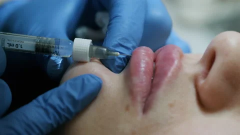 Close-up of hands of cosmetologist making injection in female lips. Woman Stock Footage 151655416