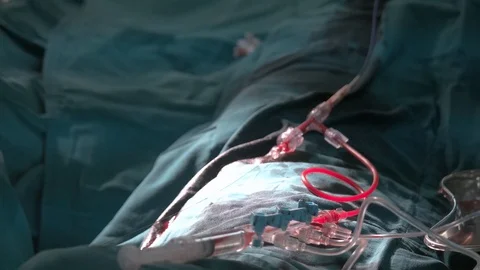 Close up hands of doctors operating in surgical room Stock Footage 129495628