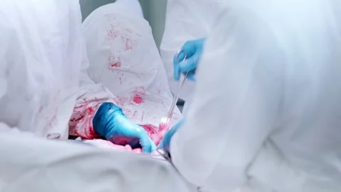 Close-up hands of professional surgeons performing operation on abdominal cavity Stock Footage 99662060