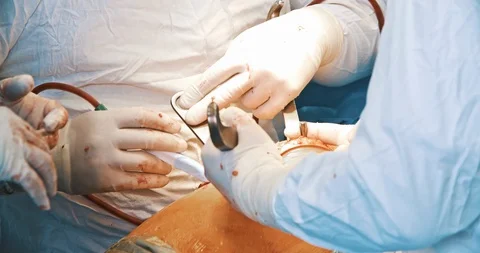 Close up of hands of surgeons team during operation with surgical laparoscopy Stock Footage 121104177