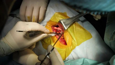 Close up hands surgical team assisting surgeon operating on patient in hospital. Stock Footage 131868390