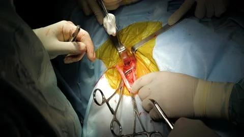 Close up hands surgical team assisting surgeon operating on patient in hospital. Stock Footage 132161448
