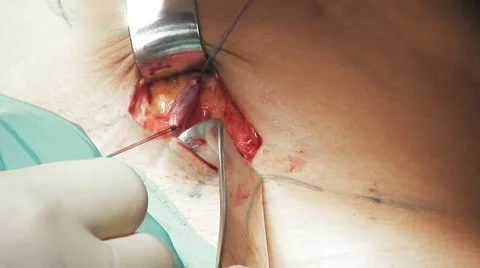 Close up hands suturing an open vein Stock Footage 67284078