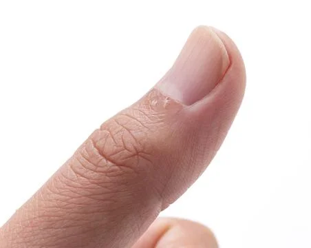 A close-up of a hangnail on a white background Stock Photos