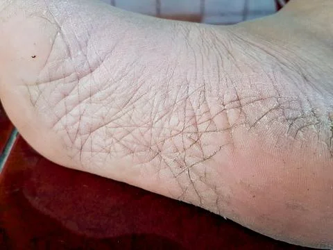 Close up of healed self harm scars on human skin. Stock Photos