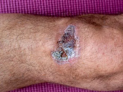 Close up of a healing knee wound with scab Stock Photos