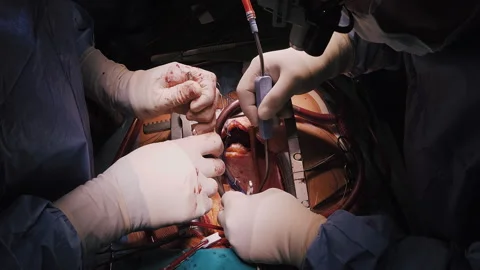 Close-up heart surgery, surgeon's hands Stock Footage 254243205