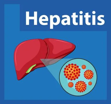 Close-Up of Hepatitis Virus Cell on Human Liver Anatomy Stock Illustration