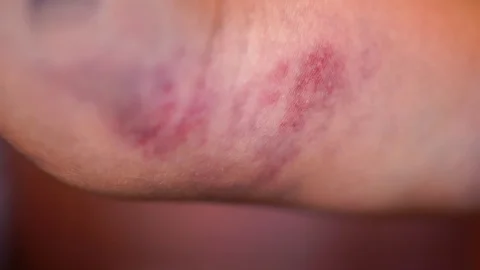Close up a huge bruise on the arm Stock Footage 127037859