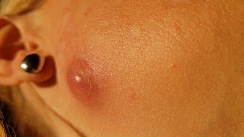 Close up huge inflamed abcess close the ear Stock Footage 99795317