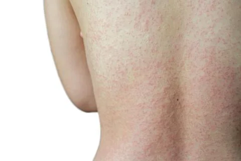 A close up of a human body back with dermatitis or eczema against white isola Stock Photos