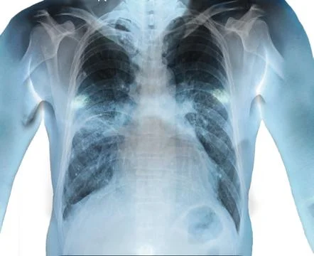 Close up Human Chest x-ray finding Cardiomegaly. Isolated background Stock Photos