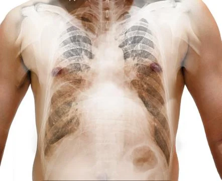 Close up Human Chest x-ray finding Cardiomegaly. Isolated background Stock Photos