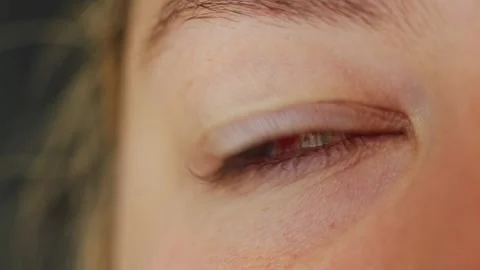 Close up of a human eye with a burst blood vessel causing redness Stock Footage 340261012