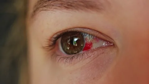 Close-up of a human eye with a subconjunctival hemorrhage showing red blood Stock Footage 340261001