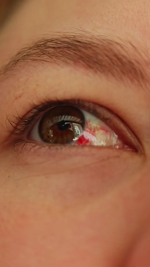 Close up of human eye with subconjunctival hemorrhage showing red blood spot Stock Footage 340261029