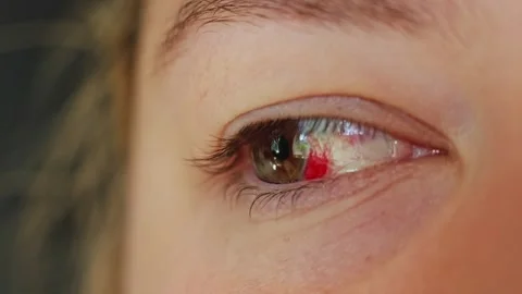 Close up of a human eye with a subconjunctival hemorrhage showing red blood Stock Footage 340261111