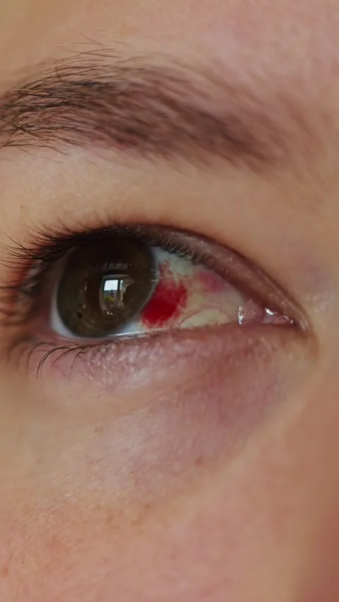 Close-up of human eye with subconjunctival hemorrhage and blinking motion Stock Footage 340261269