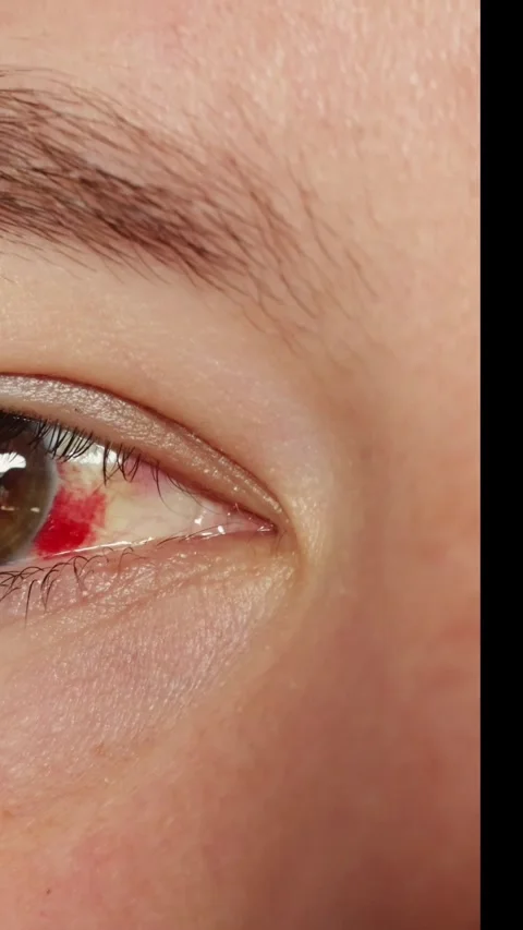 Close-up of a human eye with a subconjunctival hemorrhage showing red blood Stockbeeldmateriaal 343838013
