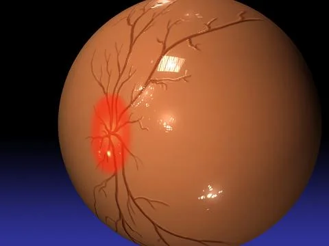 Close-up of the human eyeball with retinal damage caused by glaucoma Stock Illustration