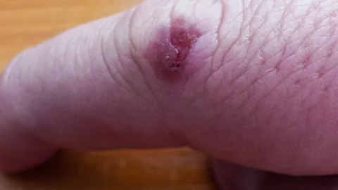 Close-up human finger knuckle red inflamed lesion scabbing on skin surface, Stock Footage 341657811