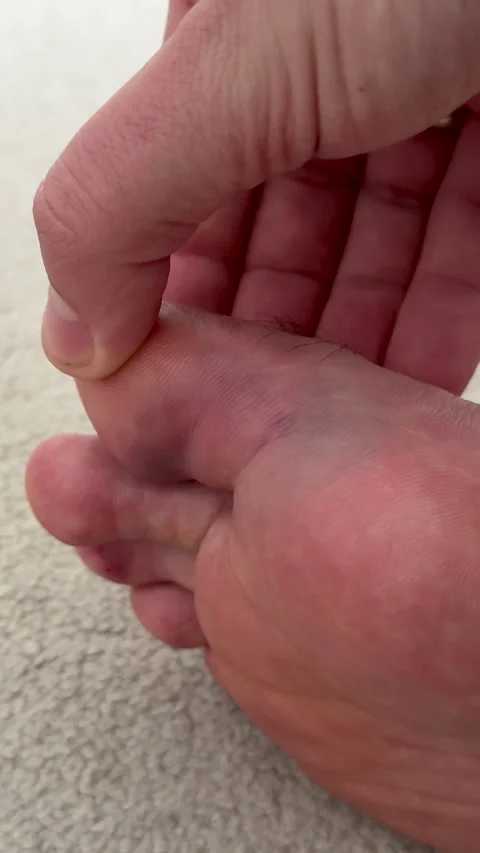 Close-up of human foot with visible bruising as hand examines injury, focusing Stockbeeldmateriaal 336546861