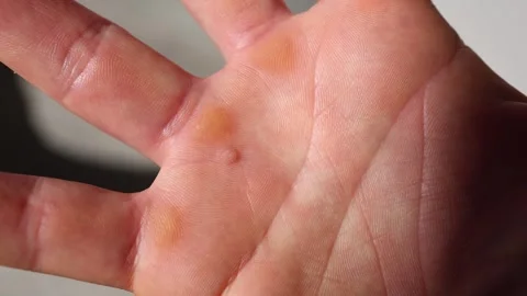 A close-up of a human palm with visible calluses and a wart. The detailed textur Stock Footage 304623317