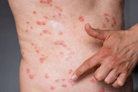 Close-up of a human torso showing psoriasis skin condition with red patches.. Foto stock
