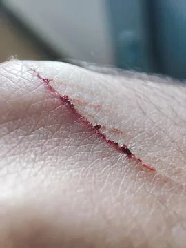 Close-up image of a bleeding wound on human skin. Foto stock